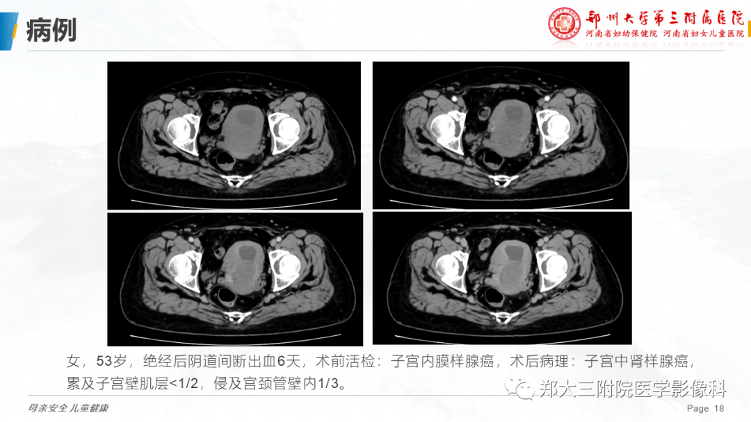 影像PPT - 【PPT】子宫中肾样腺癌-18