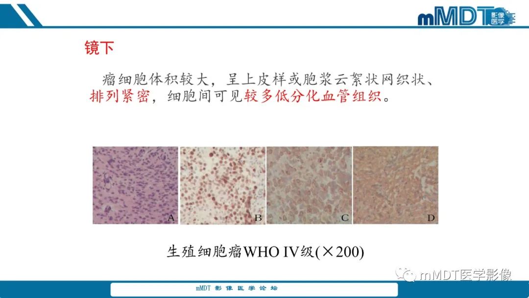 影像PPT - 【PPT】儿童颅内生殖细胞瘤的影像诊断与鉴别诊断-6