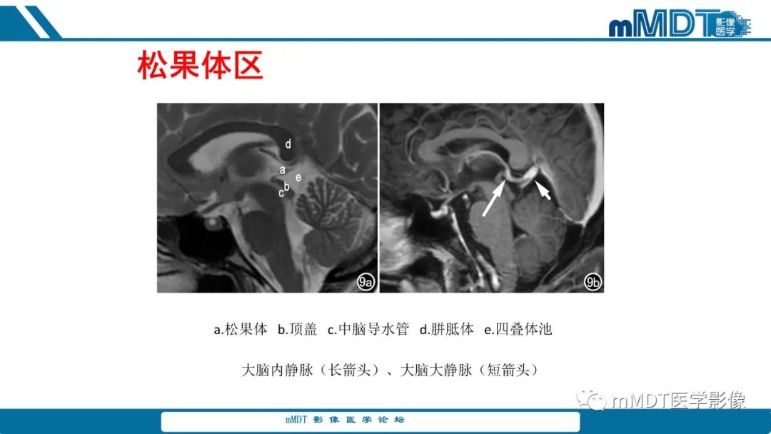 影像PPT - 【PPT】儿童颅内生殖细胞瘤的影像诊断与鉴别诊断-8