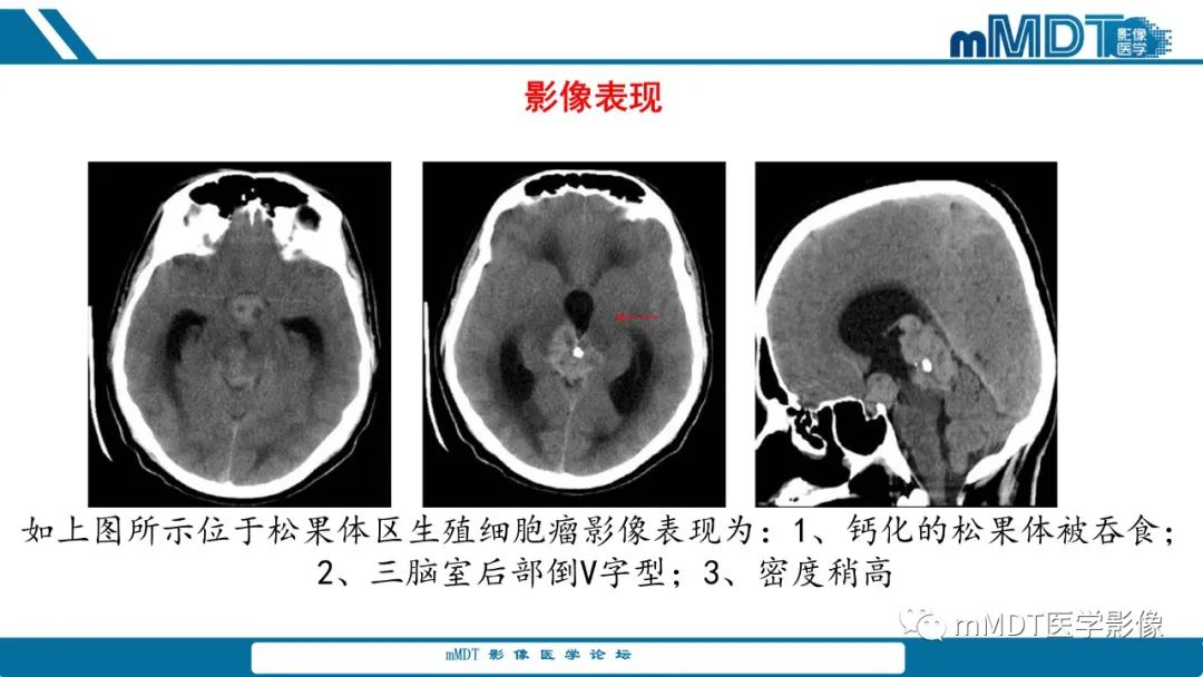 影像PPT - 【PPT】儿童颅内生殖细胞瘤的影像诊断与鉴别诊断-11