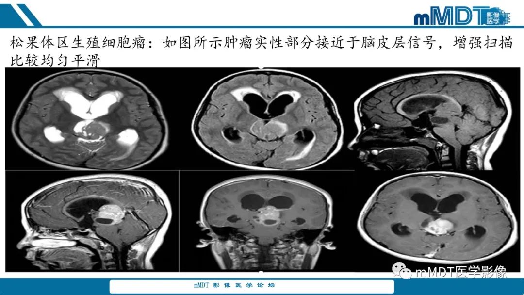 影像PPT - 【PPT】儿童颅内生殖细胞瘤的影像诊断与鉴别诊断-13
