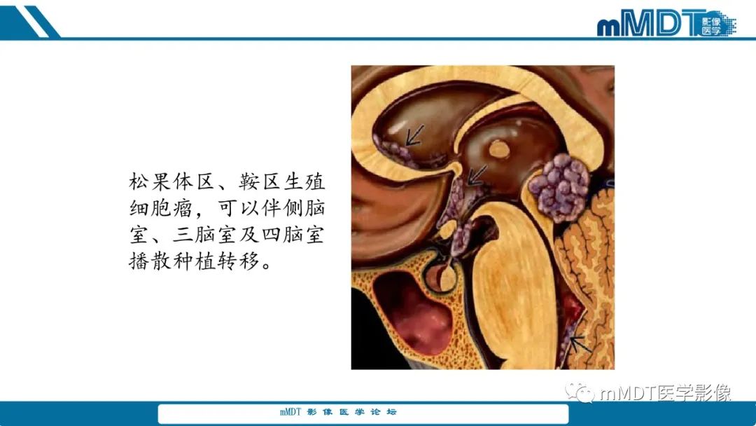 影像PPT - 【PPT】儿童颅内生殖细胞瘤的影像诊断与鉴别诊断-14