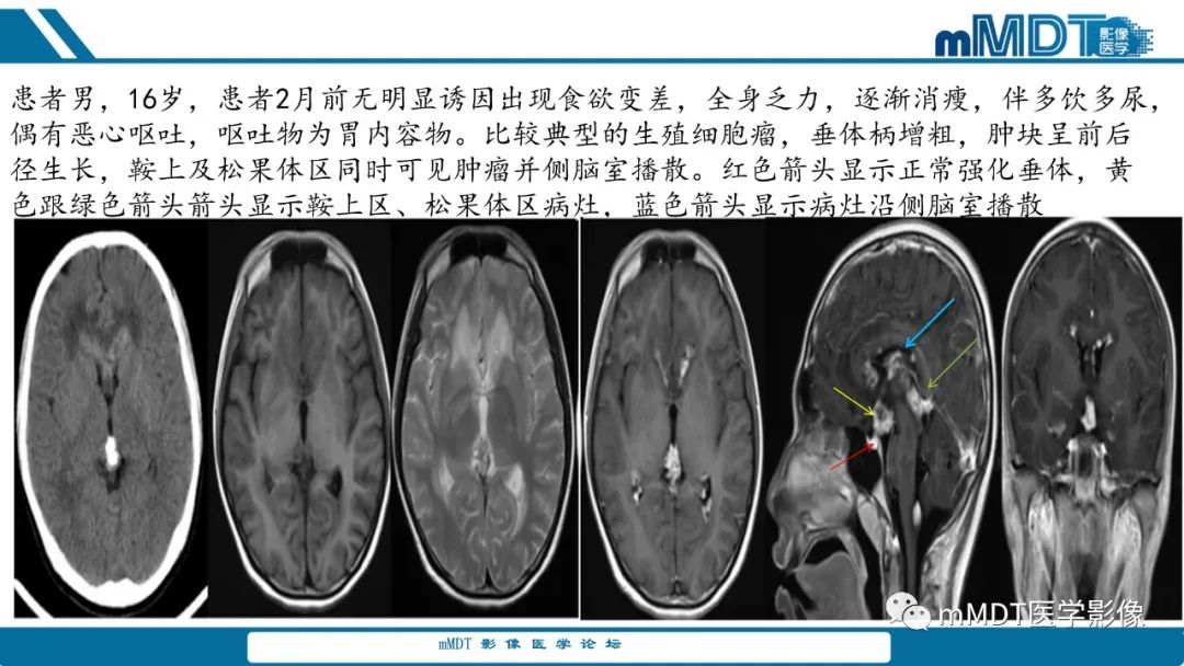 影像PPT - 【PPT】儿童颅内生殖细胞瘤的影像诊断与鉴别诊断-15