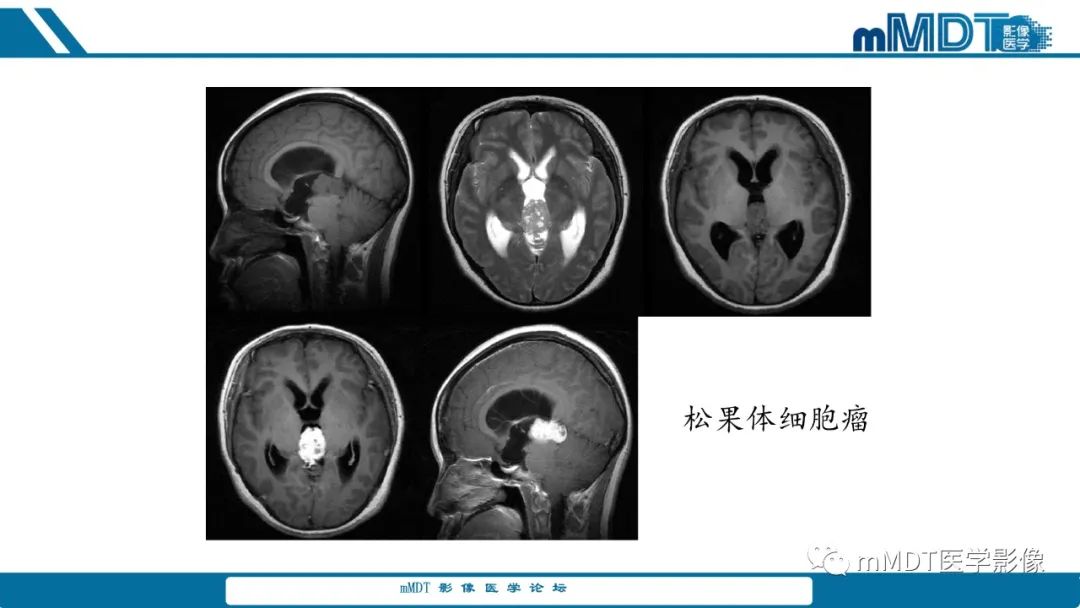 影像PPT - 【PPT】儿童颅内生殖细胞瘤的影像诊断与鉴别诊断-18