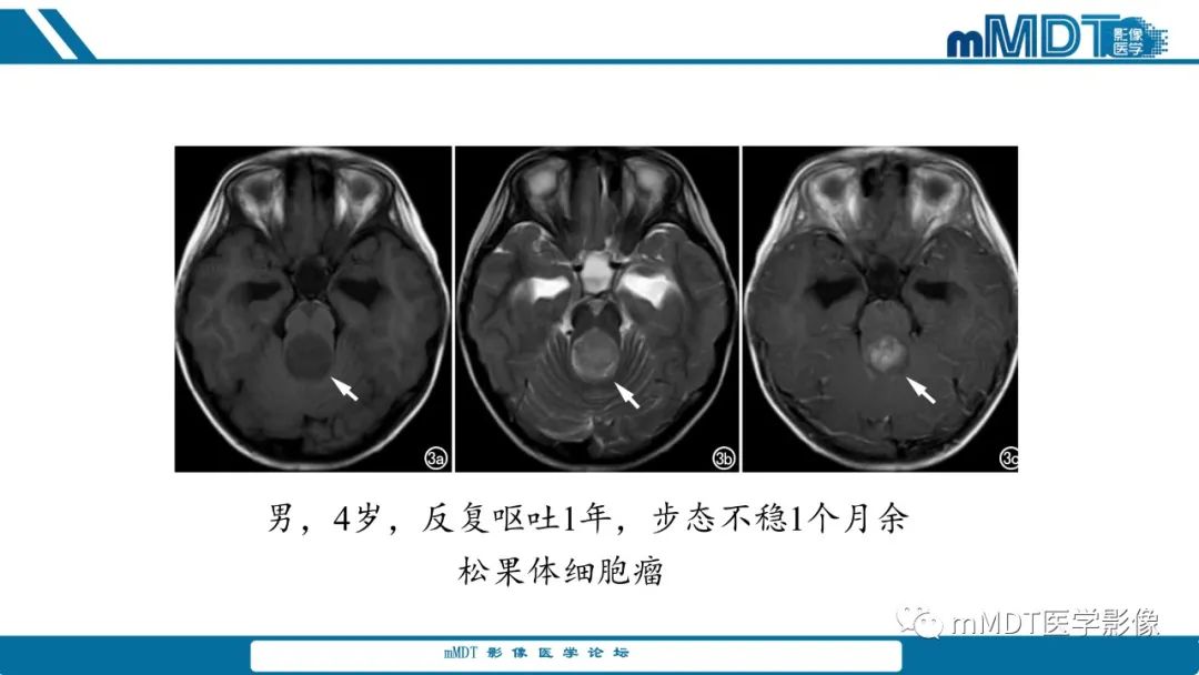 影像PPT - 【PPT】儿童颅内生殖细胞瘤的影像诊断与鉴别诊断-19