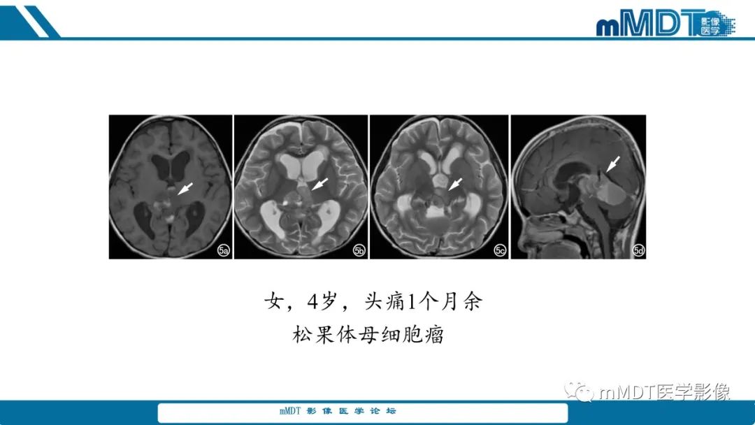 影像PPT - 【PPT】儿童颅内生殖细胞瘤的影像诊断与鉴别诊断-22