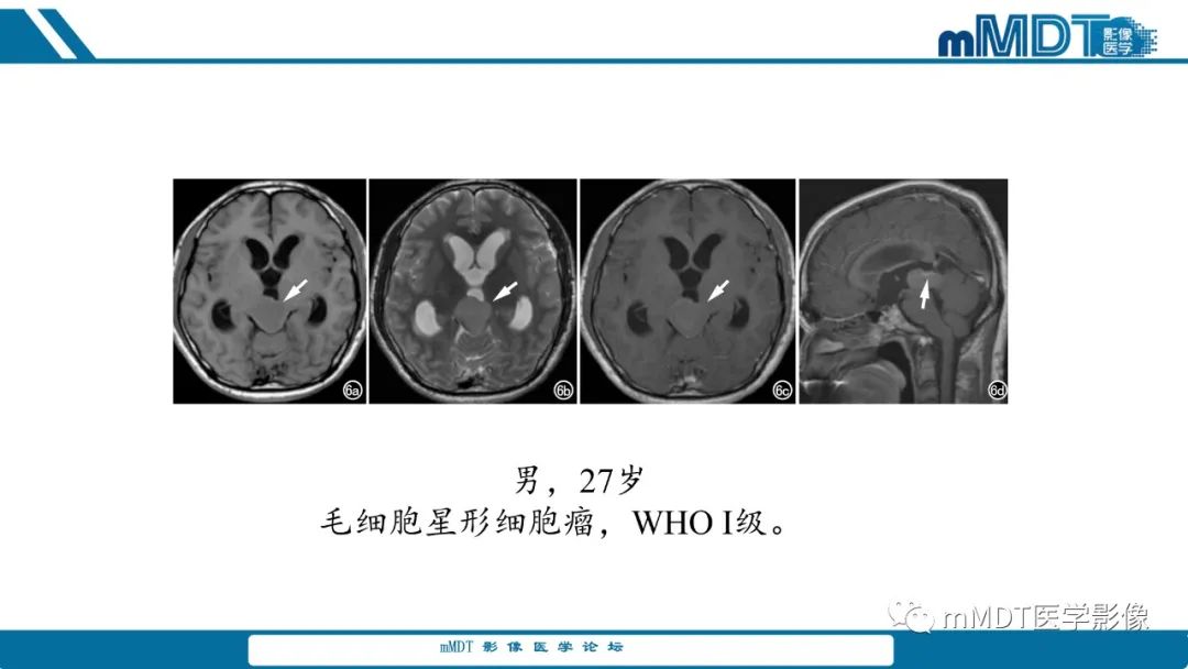 影像PPT - 【PPT】儿童颅内生殖细胞瘤的影像诊断与鉴别诊断-24