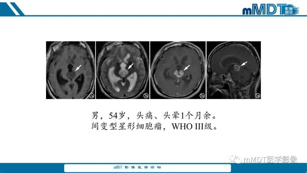 影像PPT - 【PPT】儿童颅内生殖细胞瘤的影像诊断与鉴别诊断-25