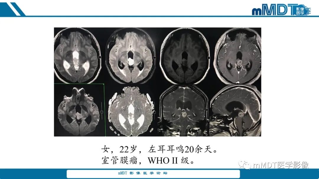 影像PPT - 【PPT】儿童颅内生殖细胞瘤的影像诊断与鉴别诊断-26