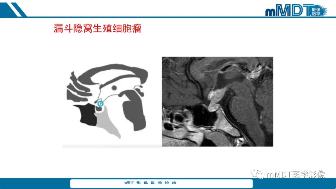 影像PPT - 【PPT】儿童颅内生殖细胞瘤的影像诊断与鉴别诊断-30