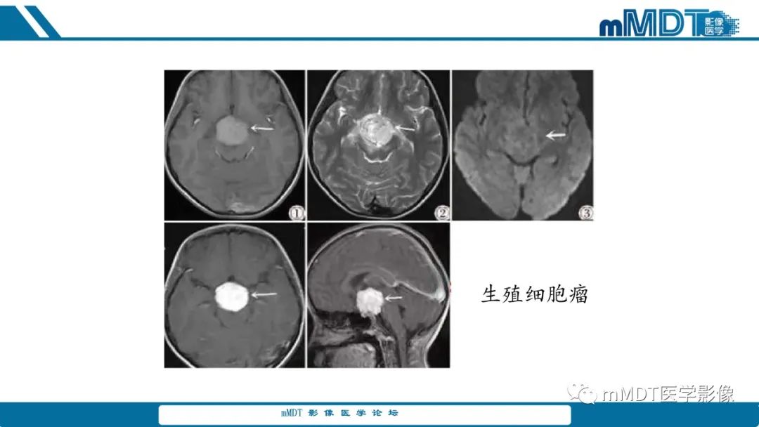 影像PPT - 【PPT】儿童颅内生殖细胞瘤的影像诊断与鉴别诊断-31
