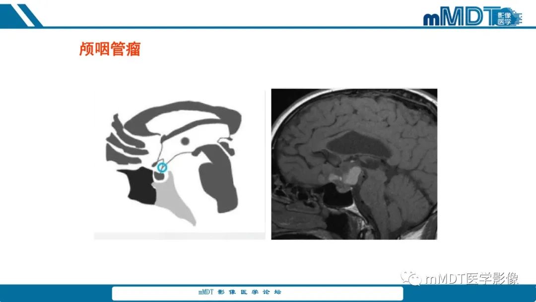 影像PPT - 【PPT】儿童颅内生殖细胞瘤的影像诊断与鉴别诊断-34