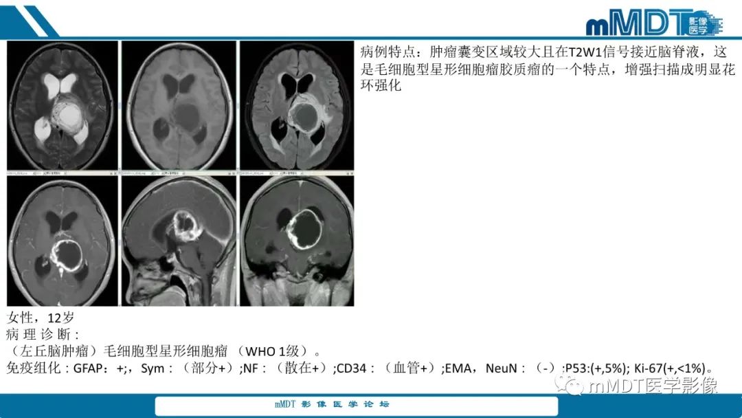 影像PPT - 【PPT】儿童颅内生殖细胞瘤的影像诊断与鉴别诊断-38