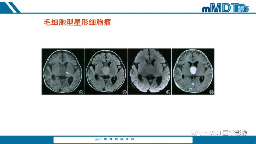 影像PPT - 【PPT】儿童颅内生殖细胞瘤的影像诊断与鉴别诊断-39