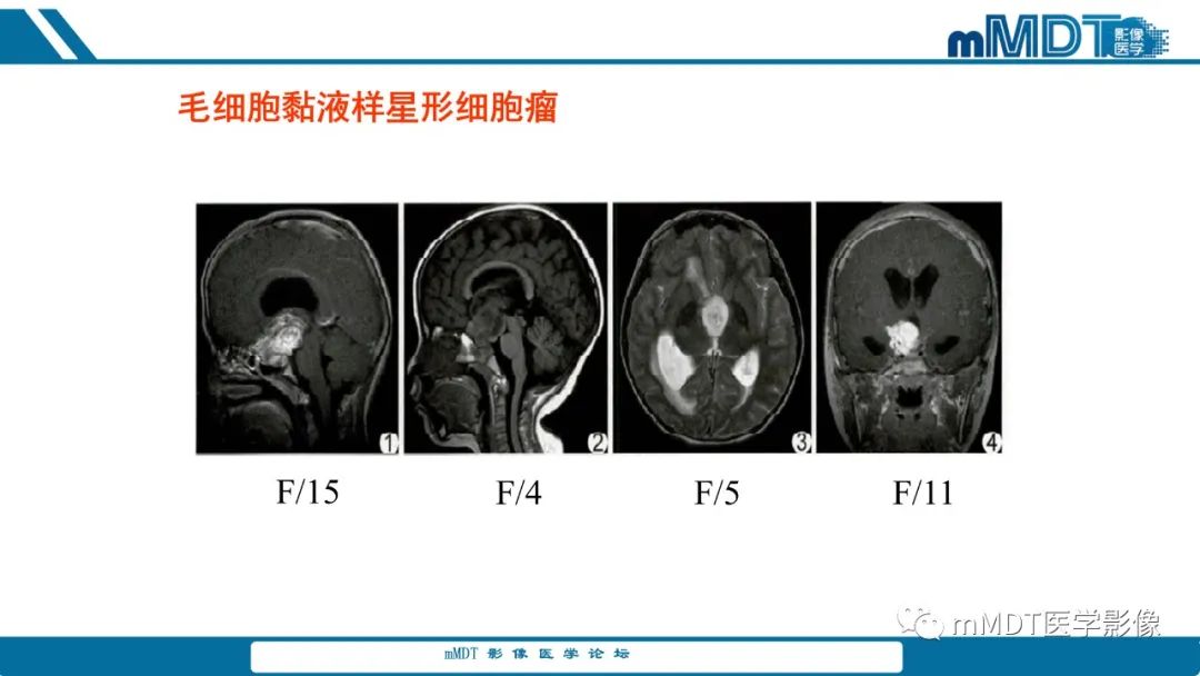 影像PPT - 【PPT】儿童颅内生殖细胞瘤的影像诊断与鉴别诊断-42