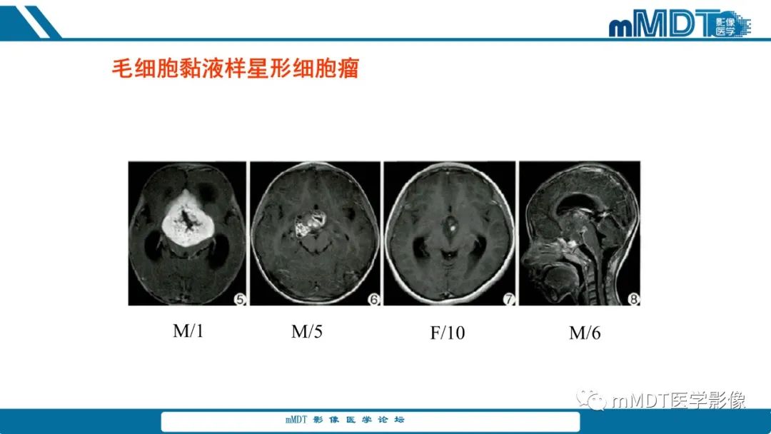 影像PPT - 【PPT】儿童颅内生殖细胞瘤的影像诊断与鉴别诊断-43