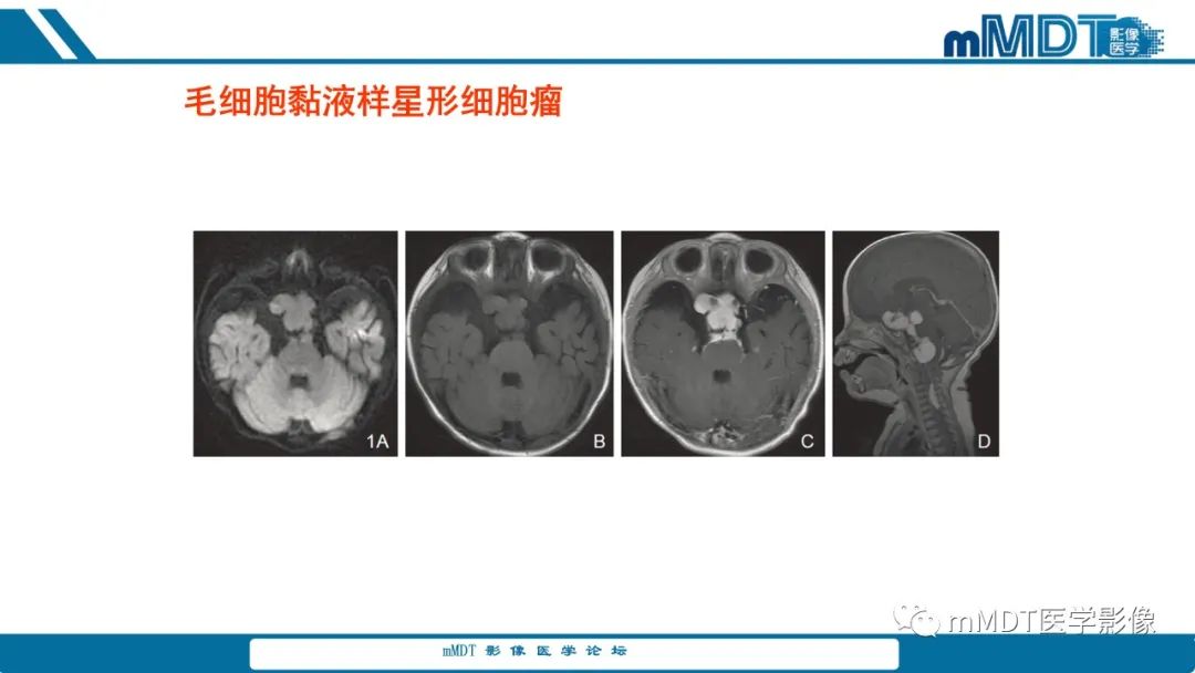 影像PPT - 【PPT】儿童颅内生殖细胞瘤的影像诊断与鉴别诊断-44