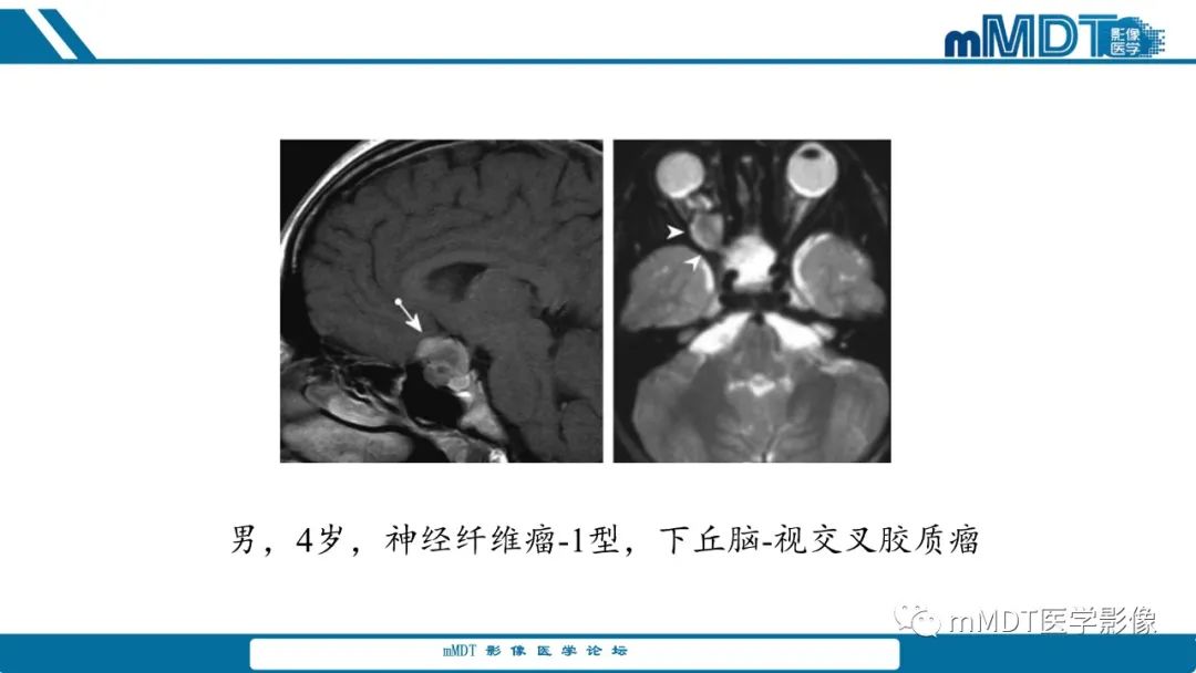影像PPT - 【PPT】儿童颅内生殖细胞瘤的影像诊断与鉴别诊断-47