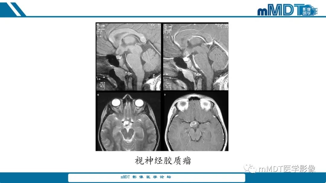 影像PPT - 【PPT】儿童颅内生殖细胞瘤的影像诊断与鉴别诊断-48