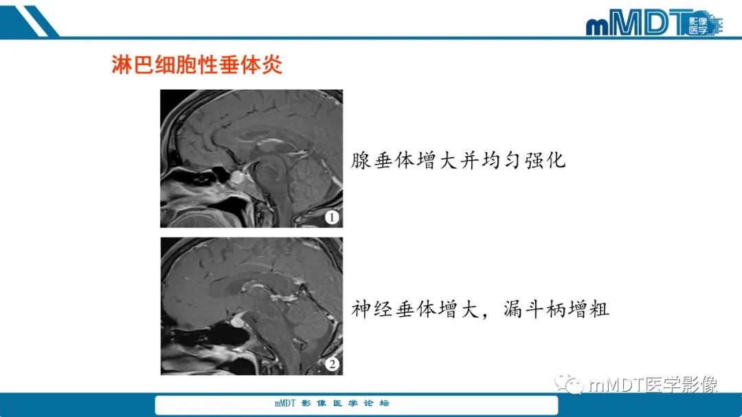 影像PPT - 【PPT】儿童颅内生殖细胞瘤的影像诊断与鉴别诊断-52