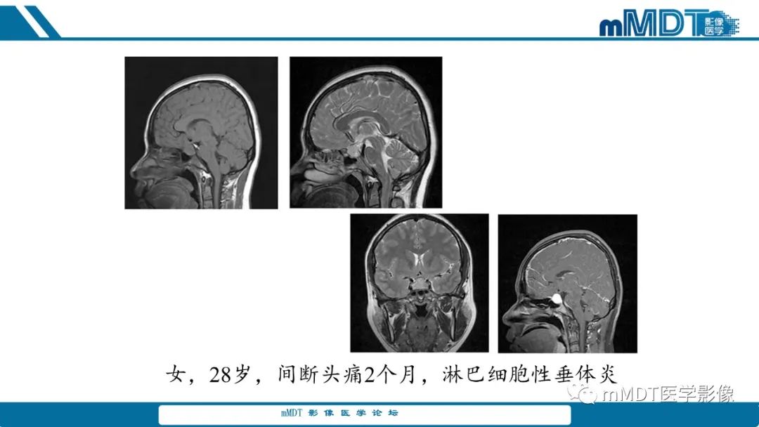 影像PPT - 【PPT】儿童颅内生殖细胞瘤的影像诊断与鉴别诊断-53