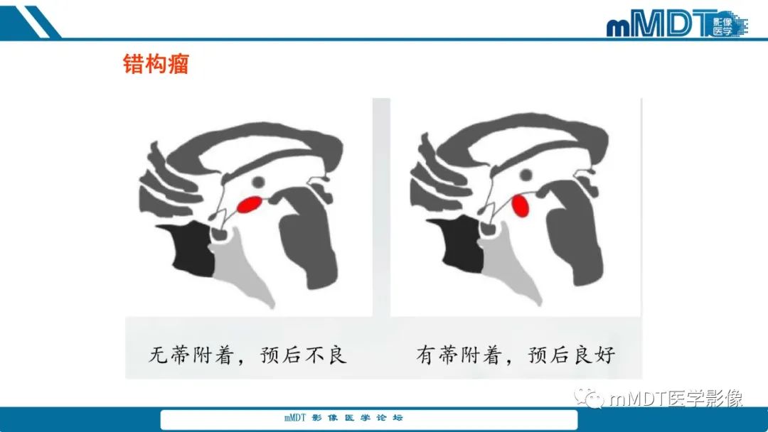 影像PPT - 【PPT】儿童颅内生殖细胞瘤的影像诊断与鉴别诊断-55