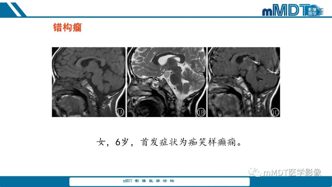 影像PPT - 【PPT】儿童颅内生殖细胞瘤的影像诊断与鉴别诊断-56