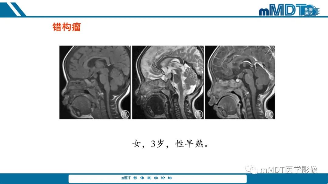 影像PPT - 【PPT】儿童颅内生殖细胞瘤的影像诊断与鉴别诊断-57