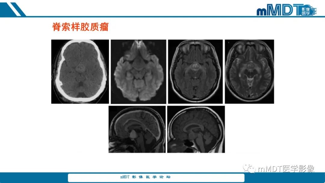 影像PPT - 【PPT】儿童颅内生殖细胞瘤的影像诊断与鉴别诊断-60