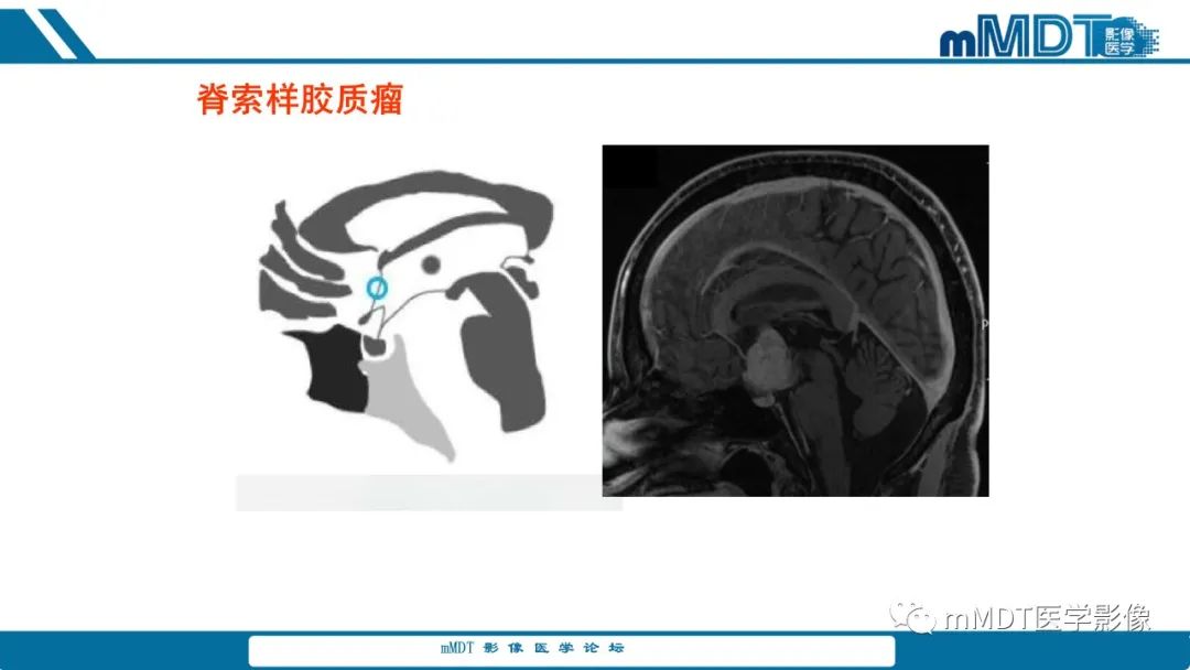 影像PPT - 【PPT】儿童颅内生殖细胞瘤的影像诊断与鉴别诊断-61