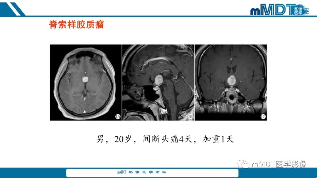 影像PPT - 【PPT】儿童颅内生殖细胞瘤的影像诊断与鉴别诊断-62