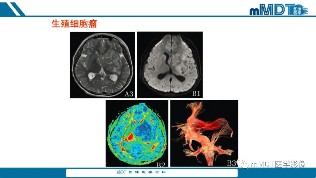 影像PPT - 【PPT】儿童颅内生殖细胞瘤的影像诊断与鉴别诊断-66