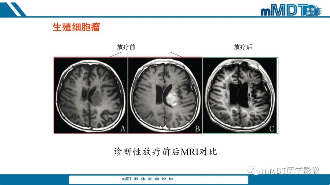 影像PPT - 【PPT】儿童颅内生殖细胞瘤的影像诊断与鉴别诊断-67