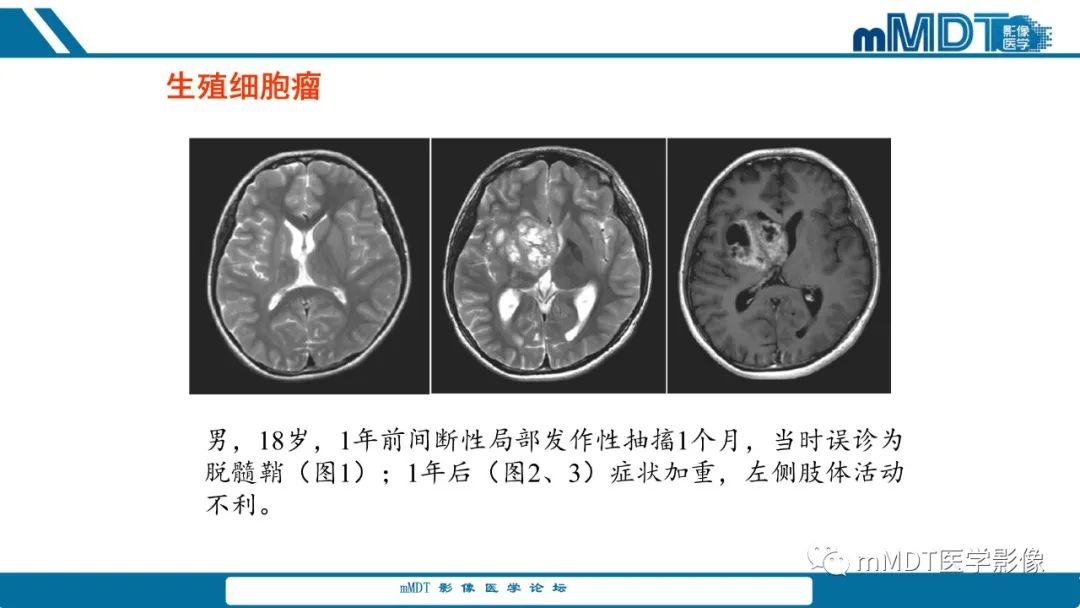 影像PPT - 【PPT】儿童颅内生殖细胞瘤的影像诊断与鉴别诊断-68