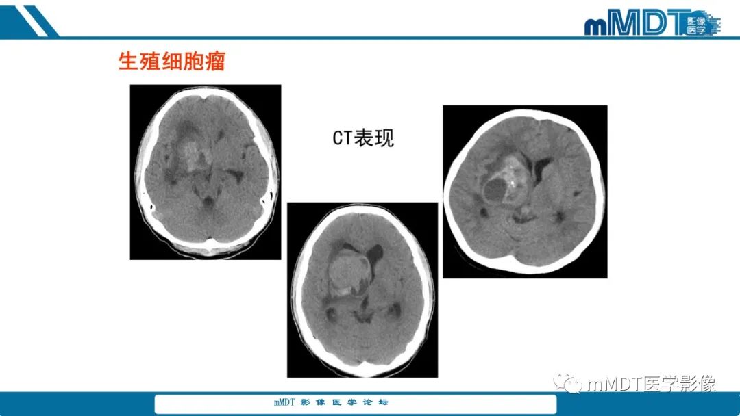 影像PPT - 【PPT】儿童颅内生殖细胞瘤的影像诊断与鉴别诊断-69
