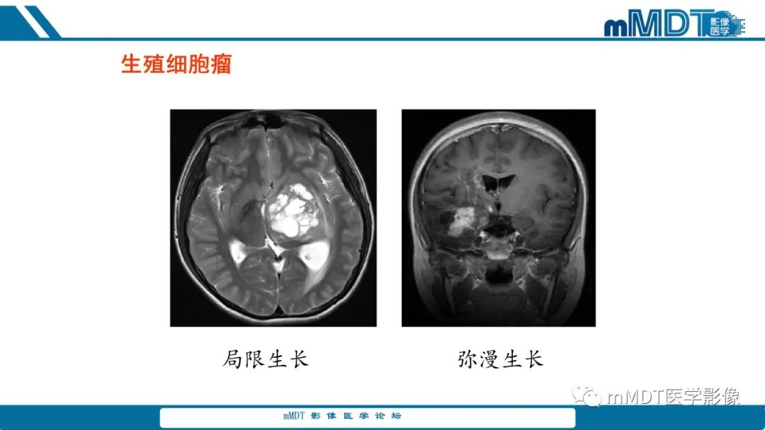 影像PPT - 【PPT】儿童颅内生殖细胞瘤的影像诊断与鉴别诊断-70
