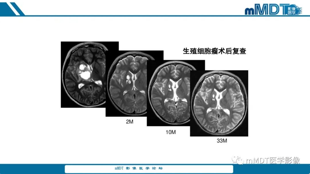 影像PPT - 【PPT】儿童颅内生殖细胞瘤的影像诊断与鉴别诊断-71