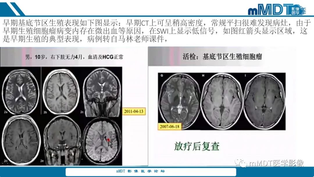 影像PPT - 【PPT】儿童颅内生殖细胞瘤的影像诊断与鉴别诊断-72
