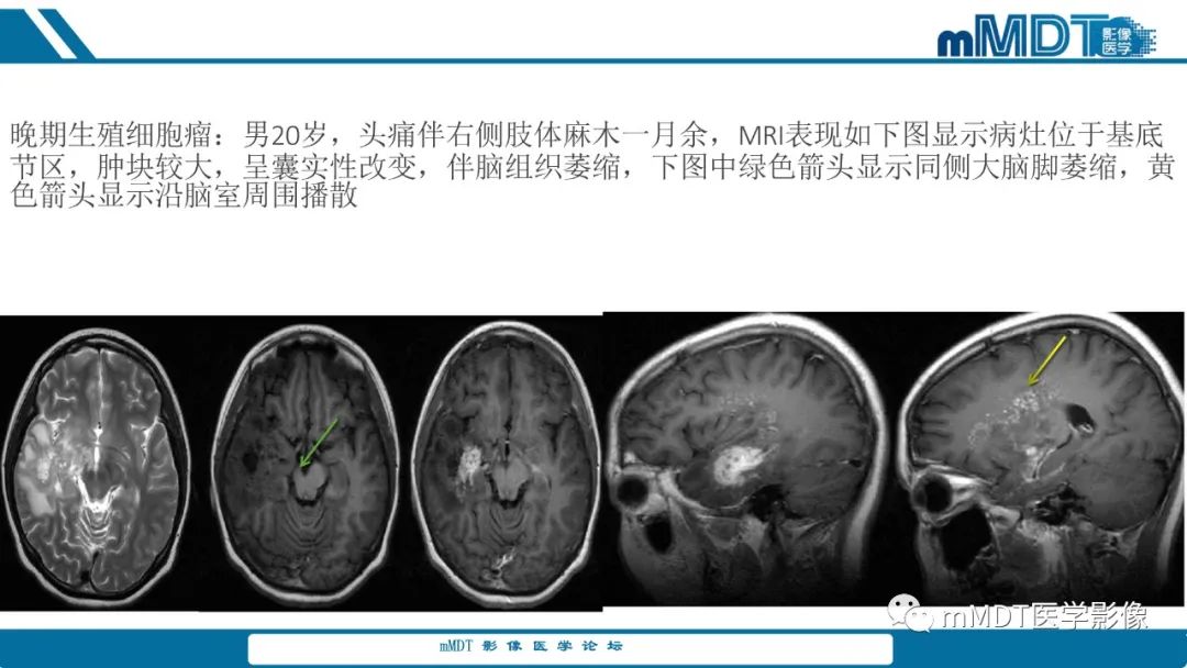 影像PPT - 【PPT】儿童颅内生殖细胞瘤的影像诊断与鉴别诊断-73