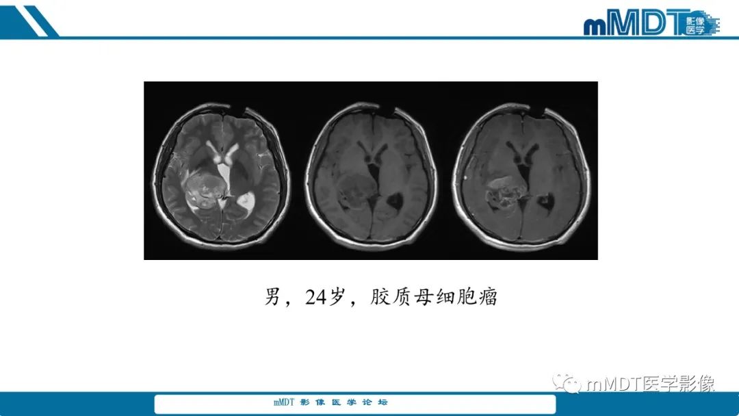 影像PPT - 【PPT】儿童颅内生殖细胞瘤的影像诊断与鉴别诊断-76