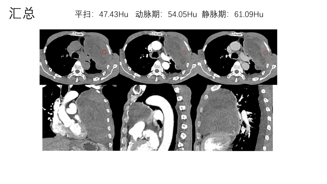 影像PPT - 【病例】胸膜孤立性纤维瘤2例CT影像-6