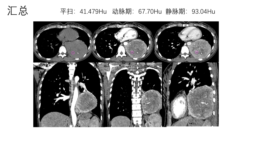 影像PPT - 【病例】胸膜孤立性纤维瘤2例CT影像-12