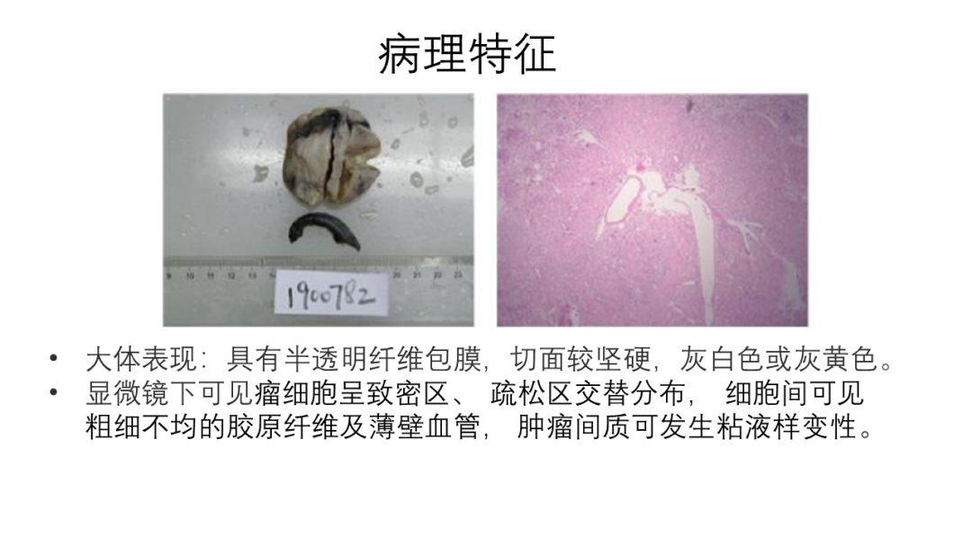 影像PPT - 【病例】胸膜孤立性纤维瘤2例CT影像-17
