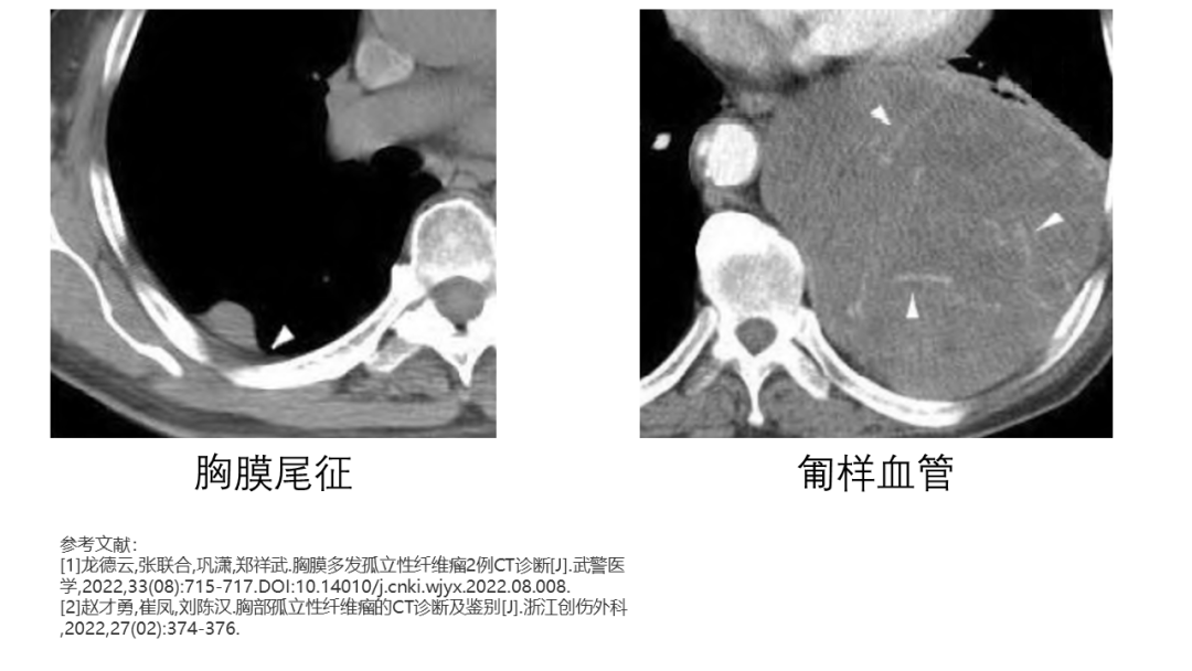 影像PPT - 【病例】胸膜孤立性纤维瘤2例CT影像-19
