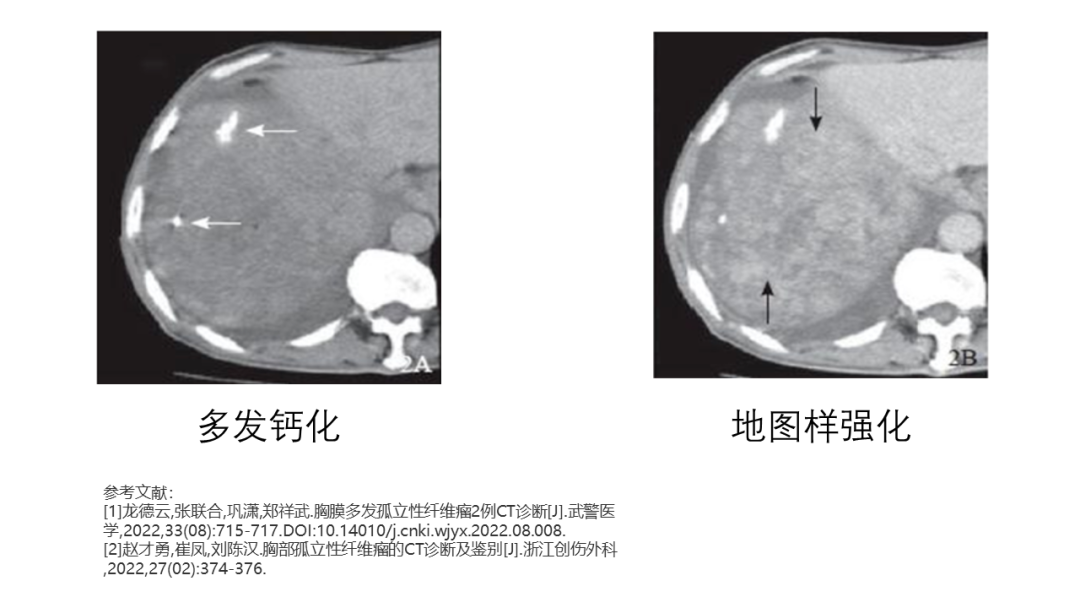 影像PPT - 【病例】胸膜孤立性纤维瘤2例CT影像-20