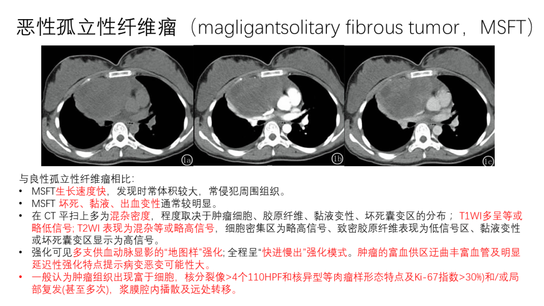 影像PPT - 【病例】胸膜孤立性纤维瘤2例CT影像-22