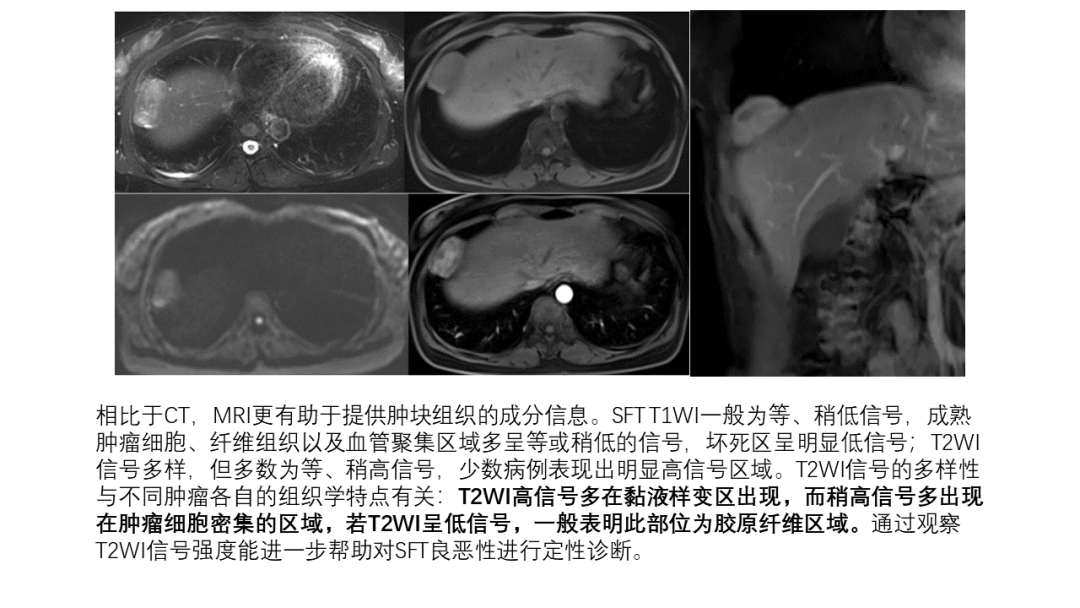 影像PPT - 【病例】胸膜孤立性纤维瘤2例CT影像-21