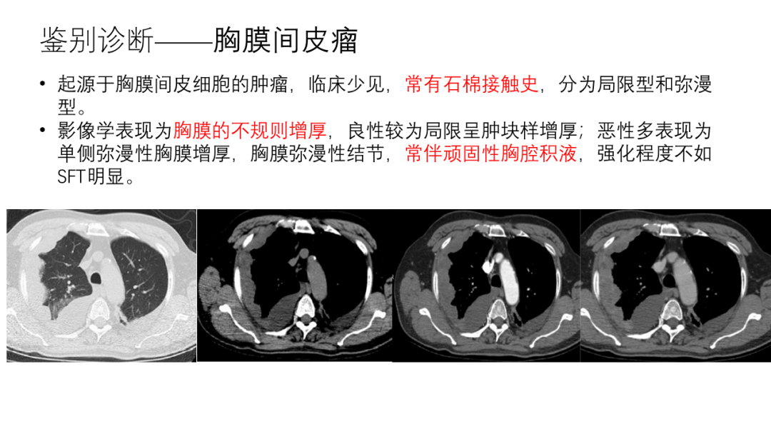 影像PPT - 【病例】胸膜孤立性纤维瘤2例CT影像-23