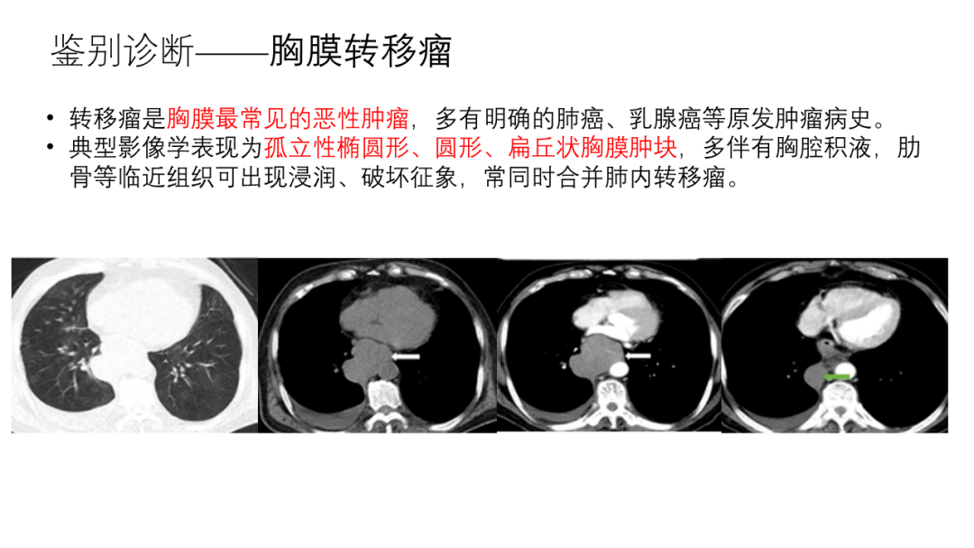 影像PPT - 【病例】胸膜孤立性纤维瘤2例CT影像-25
