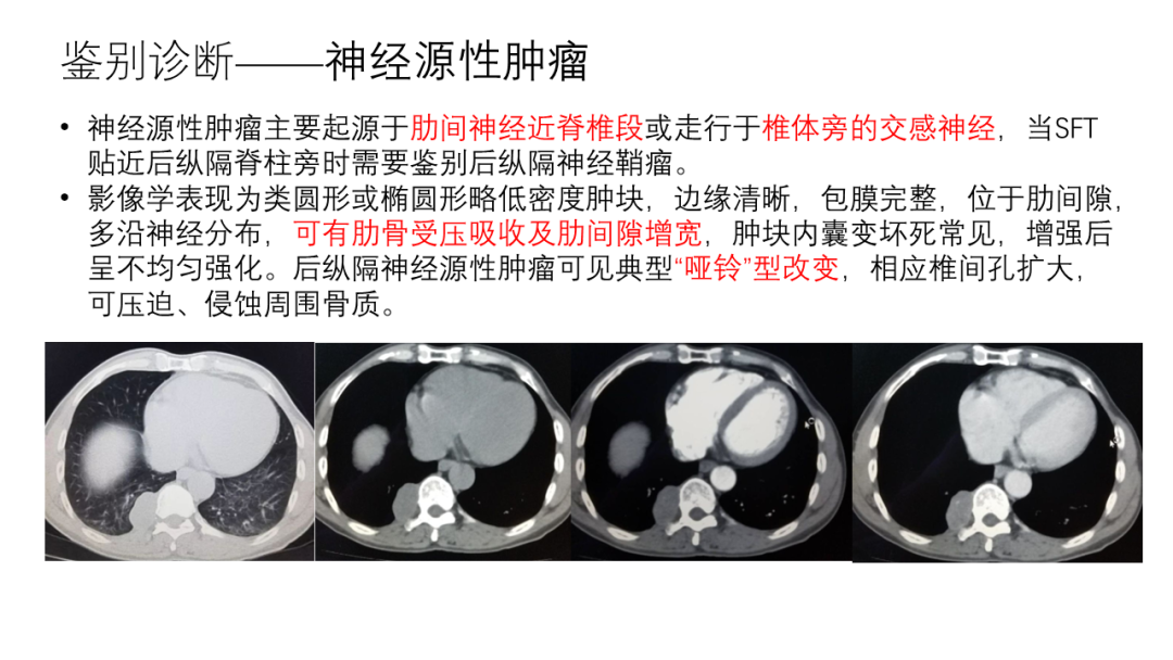影像PPT - 【病例】胸膜孤立性纤维瘤2例CT影像-24